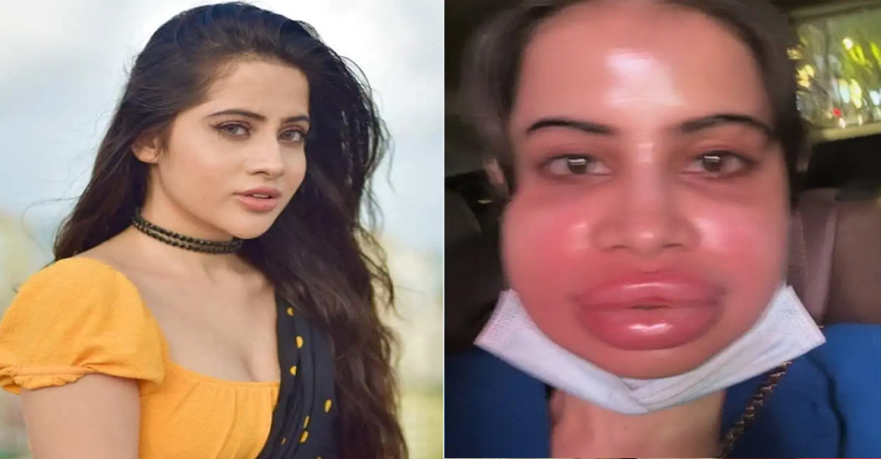 ঠোঁট ফুলে বিকৃত! পুরনো ফিলার সরাচ্ছেন উরফি জাভেদ